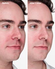 acne solutions™ clinical advanced clearing gel