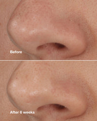 blackhead solutions self-heating blackhead extractor